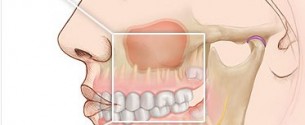 Лечение одонтогенного «зубного» гайморита