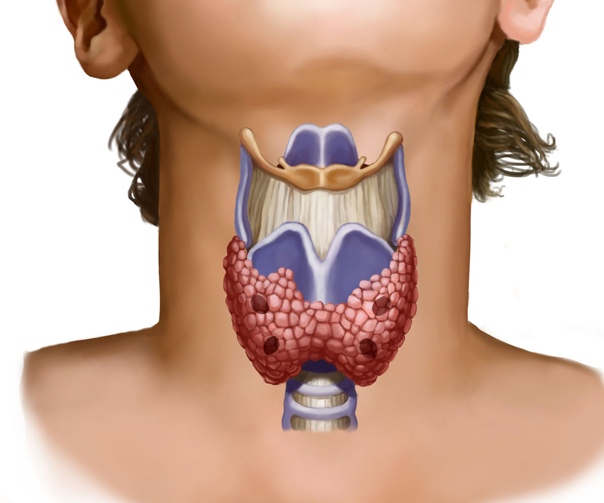 Резекция щитовидной железы