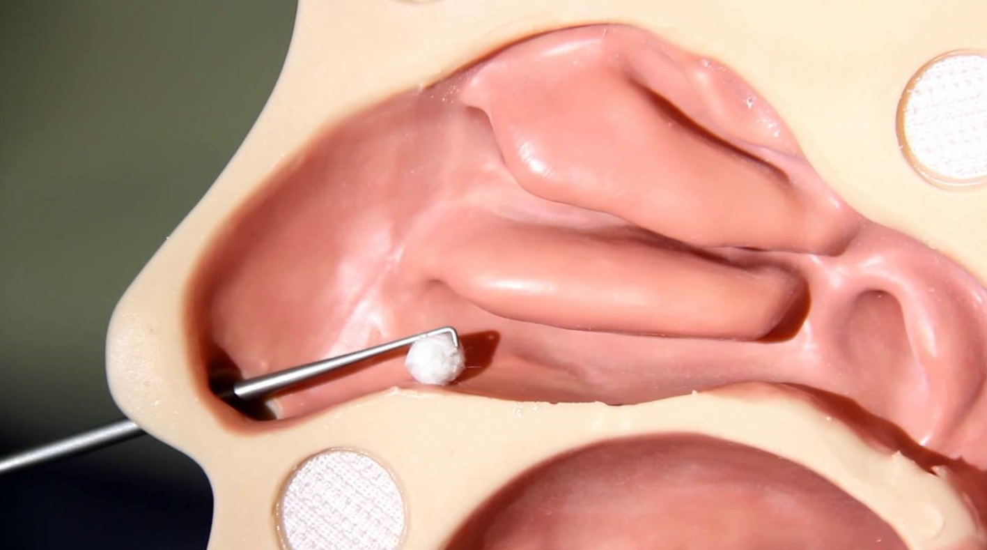 Удаление инородного тела из носа в Neo Skin