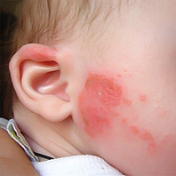 Лечение атопического дерматита у детей