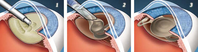 Операция на катаракте методом факоэмульсификации. Схема