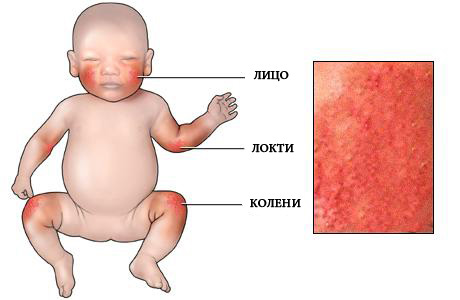 Атопической дерматит у ребенка лечение 