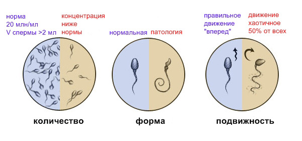 Сперматозоиды: нормальные и патология