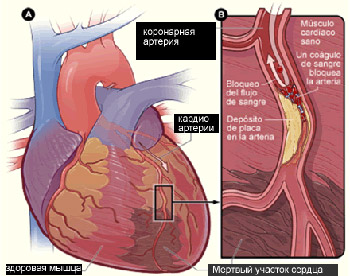Рубцовые образования при постинфарктном кардиосклерозе