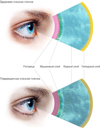Причины развития синдрома сухого глаза