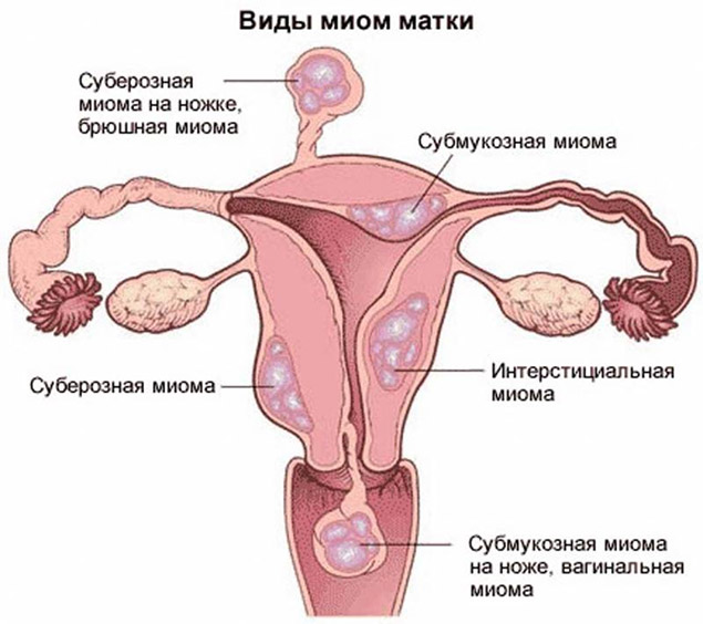 медикаментозное лечение миомы матки
